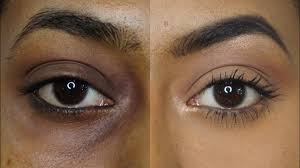 DIY Remedies to Remove Dark Circles at Home